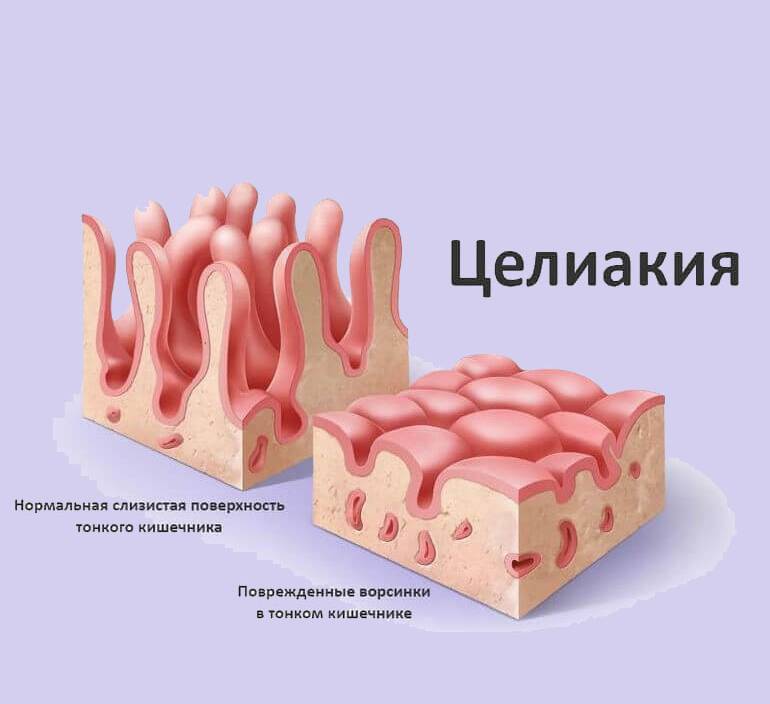 Целиакия Непереносимость глютена